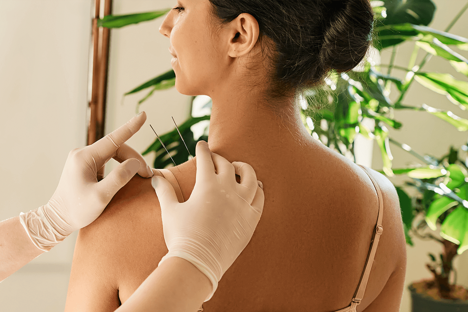 Acupuntura: o que é, benefícios e cobertura do plano de saúde