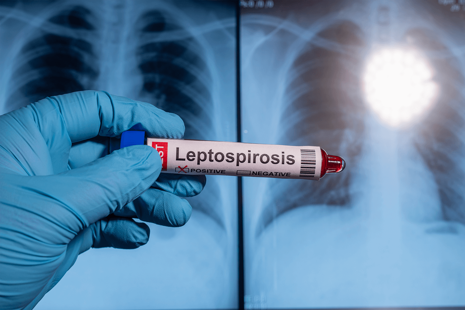 Leptospirose: o que é, sintomas e como tratar a doença